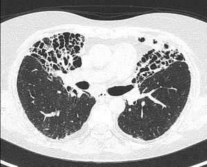 Axial high-resolution CT at the level of the upper lobes demonstrating advanced bilateral upper-lobe predominant fibrotic changes, including traction bronchiectasis, architectural distortion, and honeycombing, consistent with end-stage pulmonary sarcoidosis (Scadding stage IV).