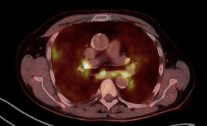 Axial 18F-FDG PET-CT at the mediastinal level showing intensely hypermetabolic bilateral hilar and mediastinal lymphadenopathy (bright foci) with diffuse low-intensity FDG uptake in the bilateral lung parenchyma, consistent with active sarcoidosis (Scadding stage II).