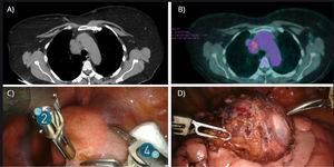 Ectopic thymoma located in the right paratracheal region. (A) CT scan showing a 37mm×26mm well-defined solid oval lesion. (B) PET/CT demonstrating nonspecific hypermetabolic uptake (SUVmax, 4.16). (C) Tumor at the right cavotracheal confluence. (D) Encapsulated specimen measuring 4.5cm×4cm.