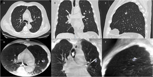 Baseline CT and procedural CBCT characteristics of a challenging peripheral pulmonary lesion (C-PPL). (A) Axial CT image showing a C-PPL in the apicoposterior segment of the left upper lobe. (B) Coronal CT view illustrating an indirect bronchus sign. (C) Sagittal CT image confirming location beyond the fifth-generation bronchus. (D) Axial CBCT image showing the lesion and the ENB catheter positioned adjacent to the target. (E) Coronal CBCT view showing the navigation catheter passing above the lesion. (F) Sagittal CBCT reconstruction providing additional information on catheter-to-target orientation.
