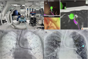 CBCT-assisted ENB in the diagnosis of a challenging peripheral pulmonary lesion (C-PPL). (A) Hybrid operating room equipped with CBCT, ENB platform, and interventional pulmonology instrumentation. (B) Navigation planning interface showing virtual pathway generation and target alignment. (C) Augmented fluoroscopy (AF) view providing real-time guidance during catheter advancement. (D) Orthogonal AF view with integrated 3-dimensional CBCT reconstruction confirming precise tool-to-lesion alignment during transbronchial forceps biopsy.