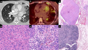 (a) CT scan showing multiple bilateral nodules; (b) PET-CT scan showing multiple nodules in the left lung with pathological uptake; (c–e) histological section at different magnifications, stained with haematoxylin–eosin, showing a pulmonary nodule with spindle-cell morphology and venous vascular localization at the level of the bronchovascular bundles; (f) EBER ISH staining.