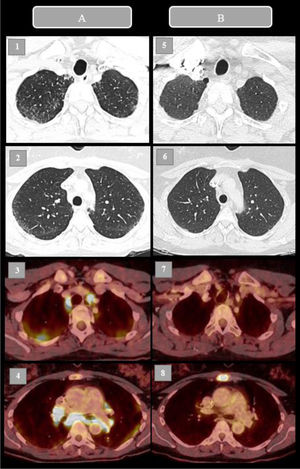 18F-FDG PET-CT before and after corticosteroid therapy for trastuzumab deruxtecan-induced sarcoidosis-like reaction. (A) Diagnostic study (left column, panels 1–4): axial CT lung-window images showing a bilateral, predominantly upper-lobe perilymphatic micronodular pattern, the morphological correlate of the FDG-avid hilar and mediastinal lymphadenopathy. (B) Control study after 6 months of corticosteroid treatment (right column, panels 5–8): fused PET-CT images demonstrating complete resolution of the pulmonary micronodules and of the mediastinal and hilar uptake. The residual focal FDG uptake in the manubrium sternum corresponds to a lytic bone metastasis from the breast carcinoma, unrelated to the sarcoidosis-like reaction.