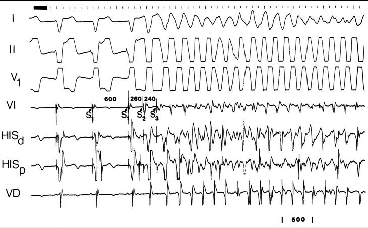 taquicardia ventricular polimórfica