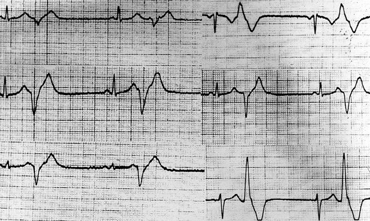 bigeminismo ventricular