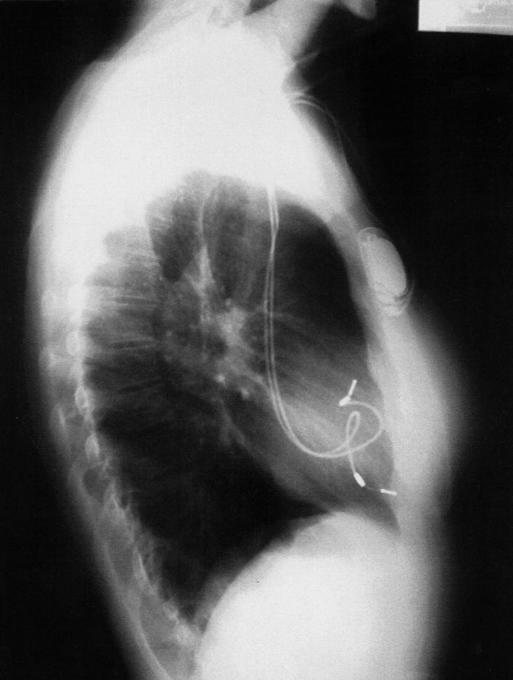 radiografia de atresia tricúspide