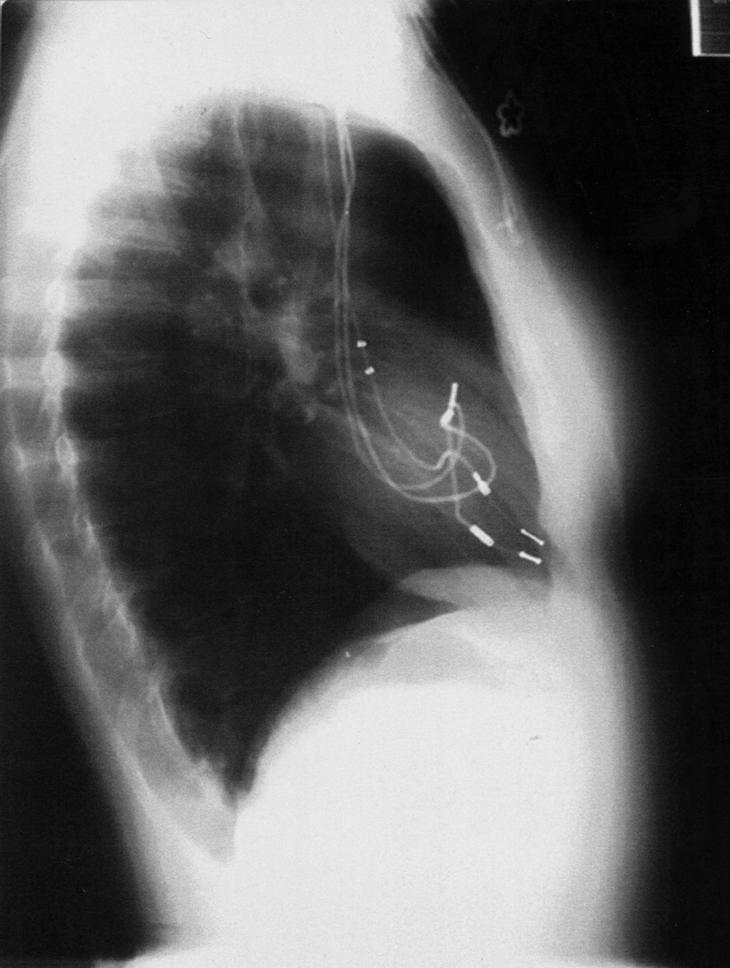 radiografia de atresia tricúspide