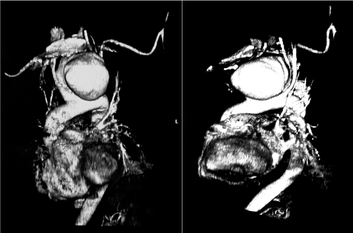 Aneurisma micótico del cayado aórtico | Revista Española de Cardiología