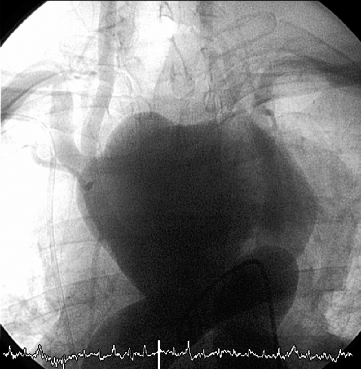 Aneurisma micótico del cayado aórtico | Revista Española de Cardiología
