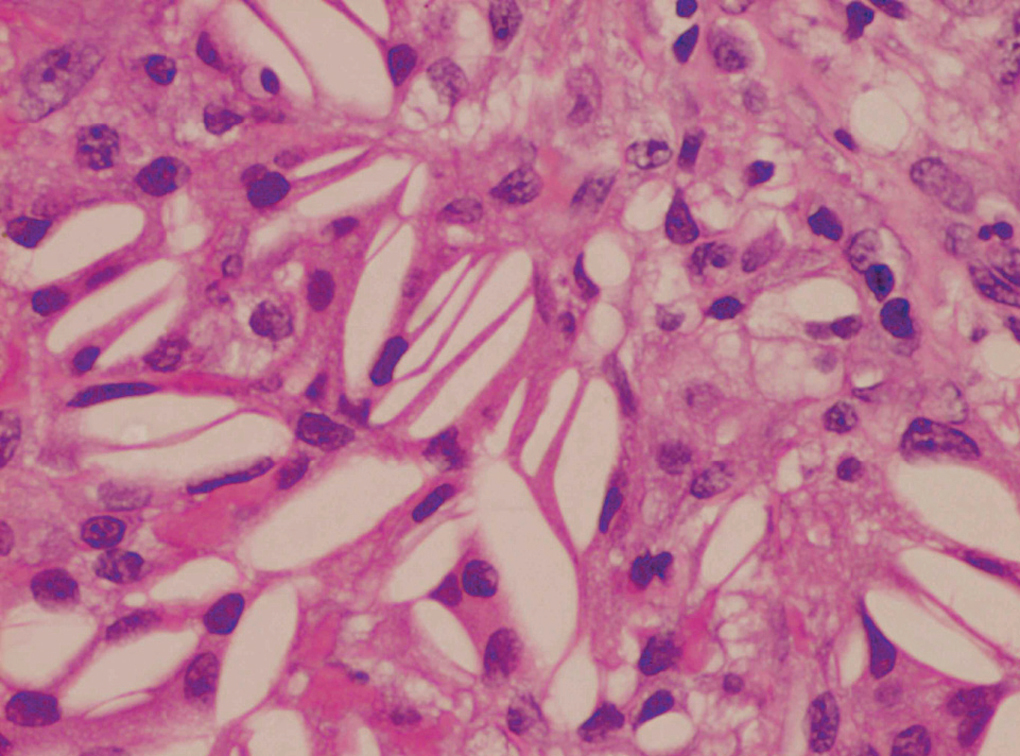 Constricción pericárdica secundaria a pericarditis por colesterol