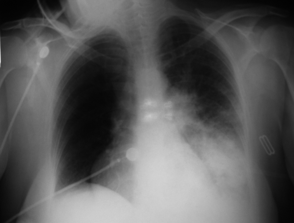 radiografía de edema pulmonar