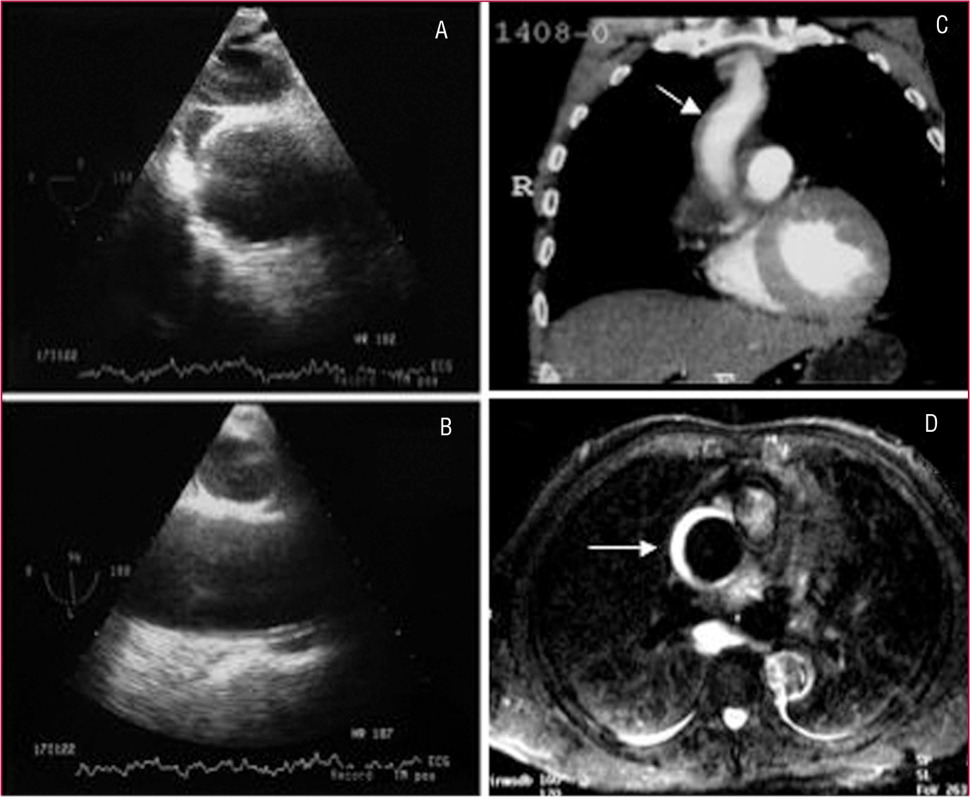 Avances En El S ndrome A rtico Agudo Revista Espa ola De Cardiolog a avances-en-el-s-ndrome-a-rtico-agudo-revista-espa-ola-de-cardiolog-a