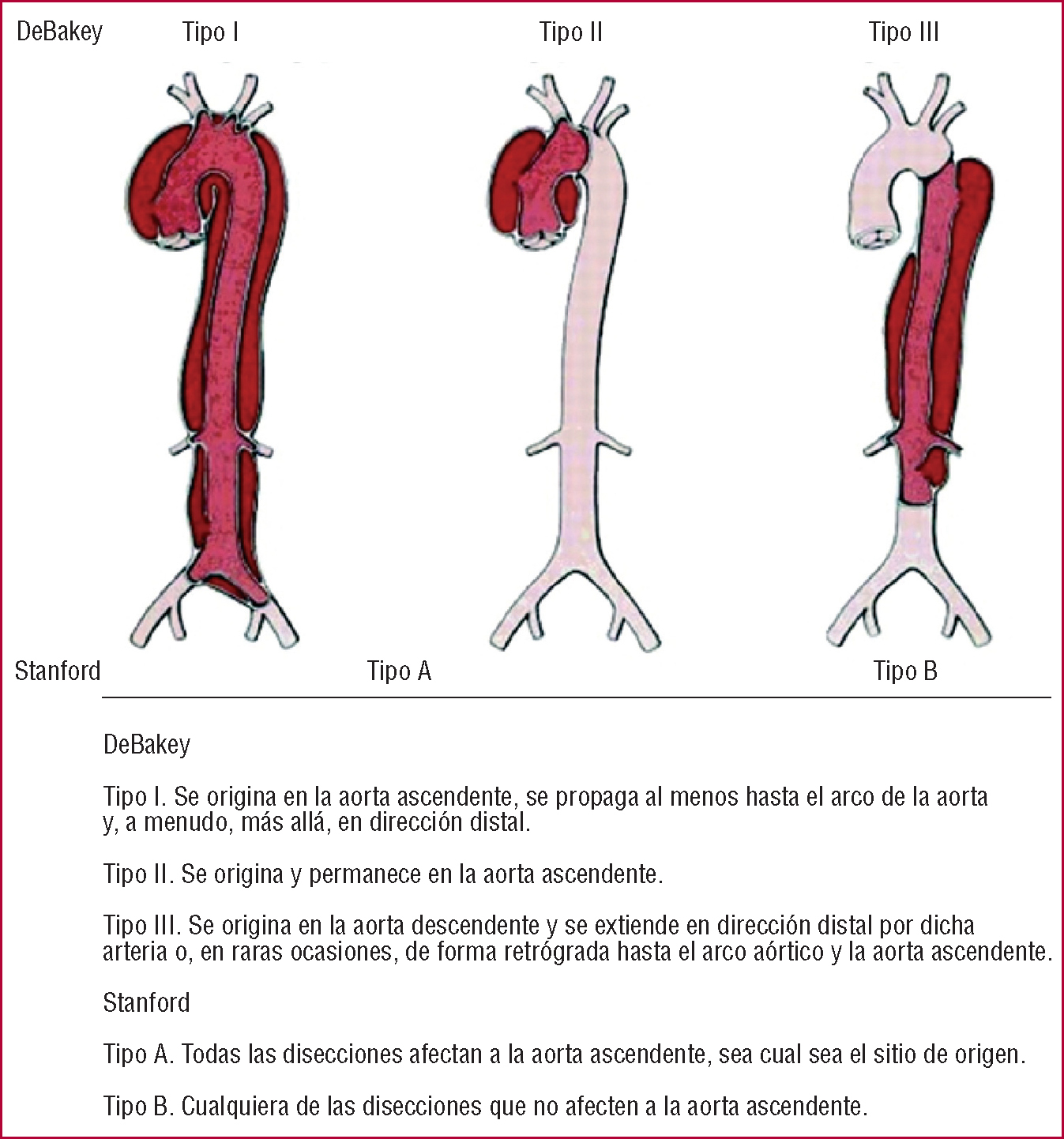 Tratamiento de los síndromes aórticos agudos - Revista Española de ...