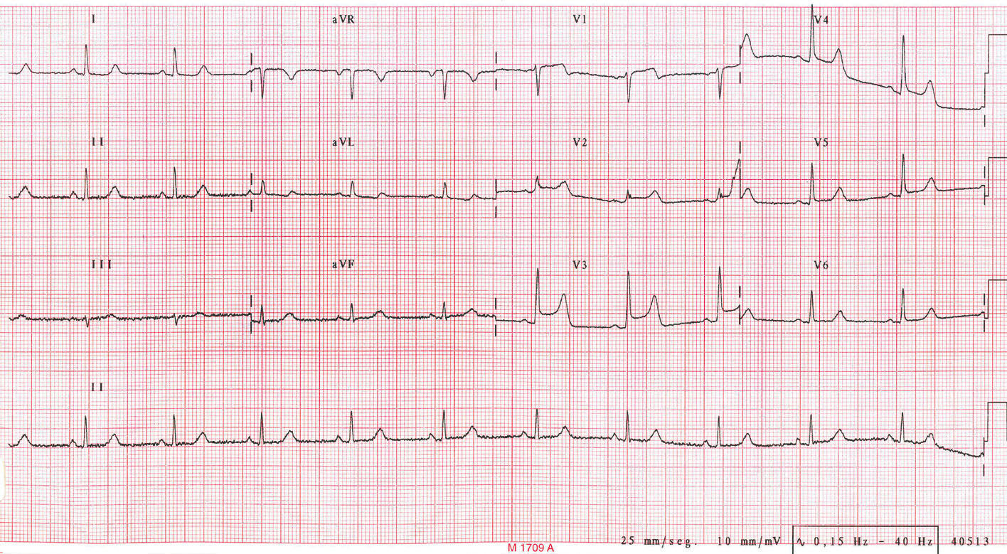 Espasmo coronario secuencial en angina variante de Prinzmetal con ...