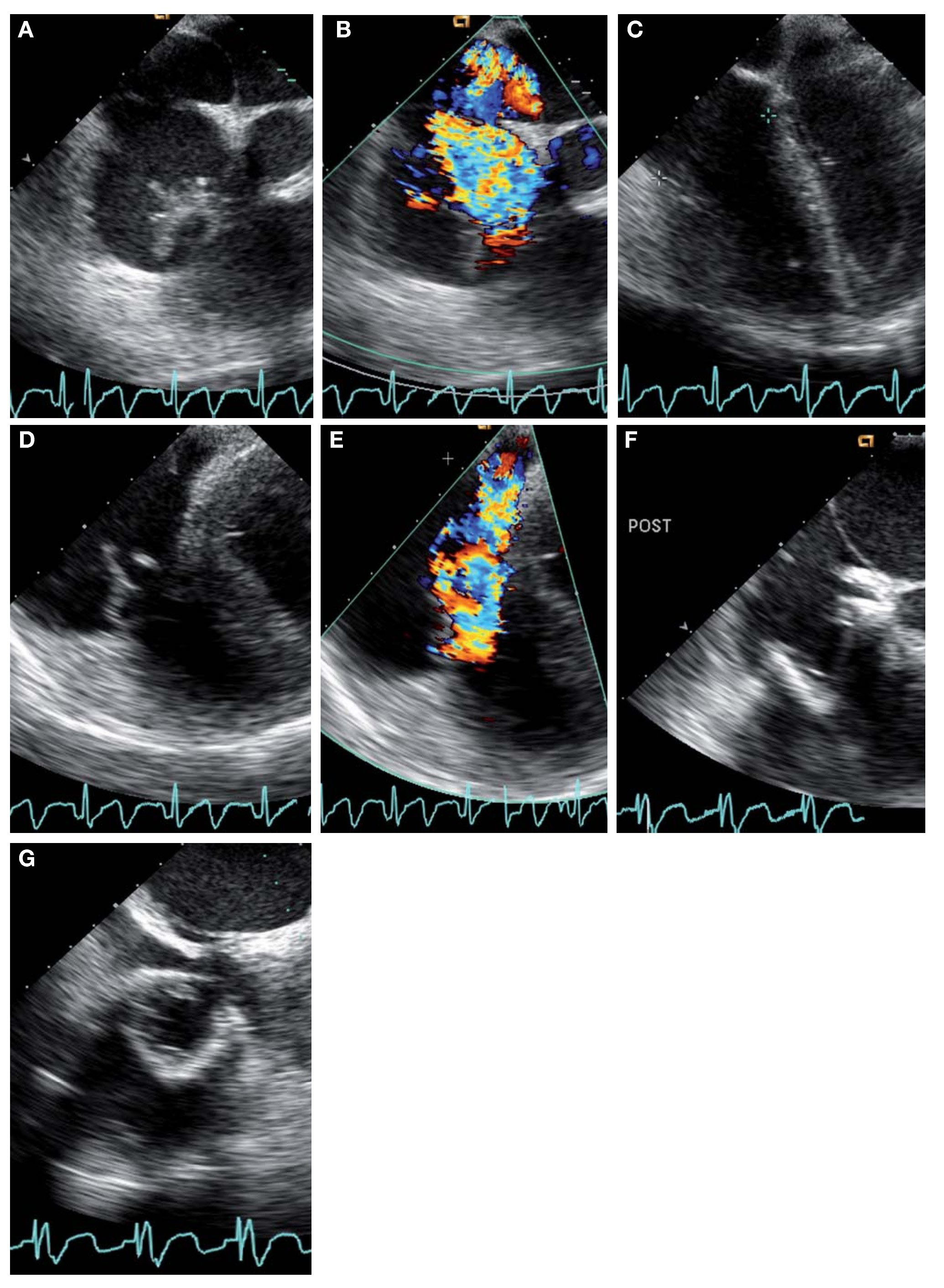 radiografia de atresia tricúspide