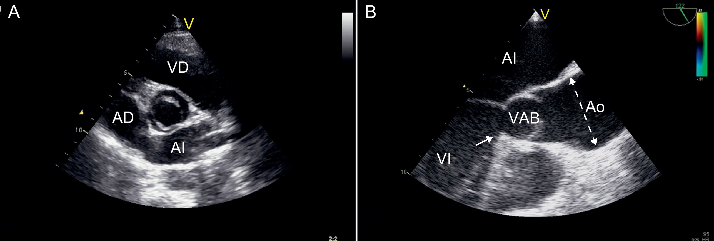 válvula aórtica bicúspide