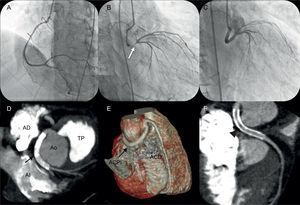 A-C: angiografía coronaria. D-F: angiografía coronaria con tomografía computarizada multicorte. ACD: arteria coronaria derecha; ACPI: arteria coronaria principal izquierda; AD: aurícula derecha; AI: aurícula izquierda; Ao: aorta; TP: tronco de la arteria pulmonar.
