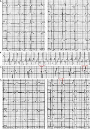 A: el ECG al ingreso mostró ritmo sinusal. B: ECG durante la taquicardia. C: ECG-Holter. D: ECG registrado después de la ablación.