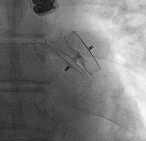 Imagen de dispositivo Amplatzer Cardiac Plug® de 28mm implantado en la orejuela izquierda.
