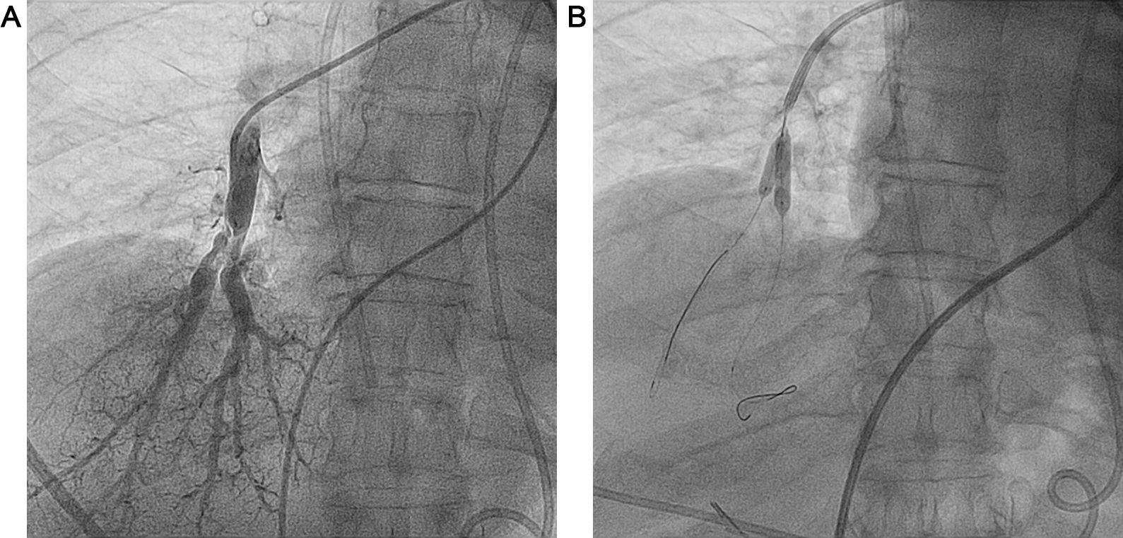 Angioplastia pulmonar con balón en la hipertensión pulmonar ...