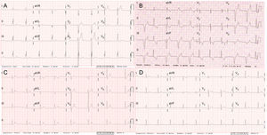Electrocardiogramas de varios portadores de la mutación p.Arg219His en SCN5A. A: electrocardiograma del caso índice III.3 (a los 30 años). B: electrocardiograma del caso II.3 (62 años). C: electrocardiograma del caso III.8 (32 años). D: electrocardiograma de la portadora asintomática II.8 (58 años).