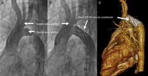 Aortografía de aorta ascendente antes y después del implante de un stent CP de 39mm en el sitio de coartación (A y B), con control posterior con tomografía computarizada con contraste (C).