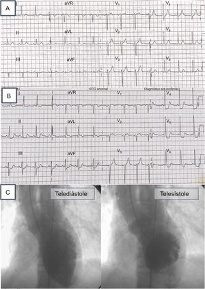 A: electrocardiograma en el momento del ingreso; B: electrocardiograma con dolor, y C: ventriculografía con patrón de tako-tsubo invertido.