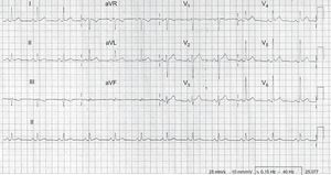Electrocardiograma: se aprecia descenso del intervalo PR y elevación cóncava del segmento ST en derivaciones I, avL, V3-6.