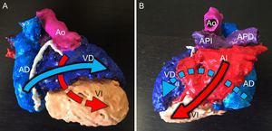 Modelo tridimensional (3D) de un paciente con conexiones auriculoventriculares cruzadas en criss-cross. A: visión anterior. B: visión posterior. Posición contralateral de la aurícula derecha (AD) y el ventrículo derecho (VD), así como de la aurícula izquierda (AI) y el ventrículo izquierdo (VI), con el consiguiente cruce de los flujos de entrada auriculoventriculares (flechas). Ao: aorta; APD: arteria pulmonar derecha; API: arteria pulmonar izquierda.