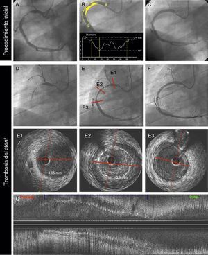 Trombosis muy tardía de un SM causada por un probable remodelado vascular positivo, en un varón de 69 años con infarto agudo de miocardio sin elevación del segmento ST. La angiografía basal (A, B y C) mostró una lesión trombótica en la arteria coronaria derecha proximal (A). B: la angiografía coronaria cuantitativa mostró un diámetro de referencia del vaso de 4,84 mm; P y D son, respectivamente, los diámetros de referencia proximal y distal del vaso. C: se trató al paciente con un SM de 4,5 × 38 mm. D: a los 18 meses, el paciente presentó una TS muy tardía; la angiografía mostró una oclusión trombótica de la arteria. E: se restableció el flujo tras aspiración del trombo. La imagen de IVUS (E1, E2, E3, G) mostró unos diámetros luminal de referencia proximal y distal de 4,9 mm (E1, E3); el segmento tratado con el stent mostró un probable remodelado positivo del vaso (diámetro luminal de 6,9mm) con una gran malaposición (E2 y G: vistas axial y longitudinal respectivamente). Se trató al paciente con un balón no distensible de 6,0 × 15 mm. IVUS: ecografía intravascular; SM: stent metálico; TS: trombosis del stent.