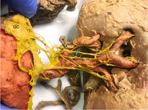 Riñón izquierdo (RI), visión anterior. Se observa un gran nervio (*) originado en el ganglio celiaco (GC). Se puede observar que hay haces de nervios que se unen a la arteria segmentaria posterior izquierda (ASP). En rojo, aorta (Ao) y arterias renales (AR), segmentarias y subsegmentarias. En amarillo, el simpático renal. Esta figura se muestra a todo color solo en la versión electrónica del artículo.