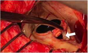 Visión quirúrgica de una dehiscencia paravalvular (flecha).