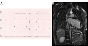 Paciente 1. A: ECG con bajo voltaje e inversión de la onda T en las derivaciones precordiales derechas. B: cardiorresonancia magnética con realce tardío de gadolinio subepicárdico, sobre todo en la pared ventricular basal e inferior media del ventrículo izquierdo.