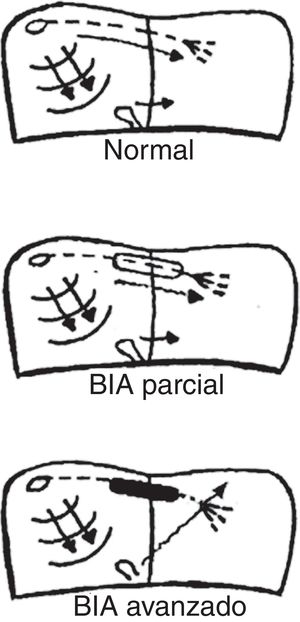Activación auricular en sujetos sanos (normal), con bloqueo interauricular (BIA) parcial y avanzado.