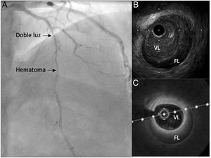 Imagen de disección coronaria espontánea. A: angiografía coronaria típica. B: ecografía intracoronaria. C: tomografía de coherencia óptica. FL: falsa luz; VL: verdadera luz.
