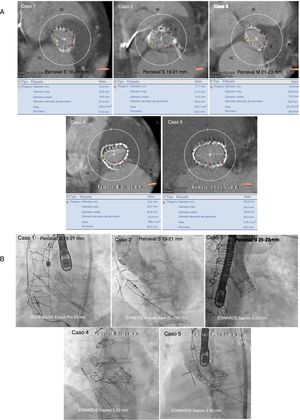 A: mediciones de tomografía computarizada (diámetros, diámetro derivado del perímetro, se especifica el área y el perímetro debajo de cada caso) de las dimensiones del anillo de la válvula aórtica sin sutura que presenta el fallo. B: resultado angiográfico final de las intervenciones de válvula en válvula con diferentes tipos de válvulas cardiacas percutáneas utilizadas en fallos de válvulas aórticas sin sutura. Esta figura se muestra a todo color solo en la versión electrónica del artículo.