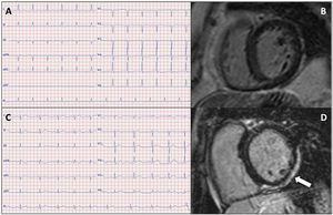 A: electrocardiograma del caso índice (II.2). B: resonancia magnética cardiaca de la misma paciente, sin realce tardío de gadolinio. C: electrocardiograma del nieto de la paciente caso índice (IV.2). D: resonancia magnética cardiaca del mismo paciente; patrón de realce tardío de gadolinio subepicárdico en las caras inferior y lateral del ventrículo izquierdo (flecha).