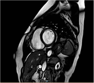 Leve realce tardío de gadolinio en la parte media del miocardio de los segmentos anteroseptal-septal-inferoseptal y basal medial.