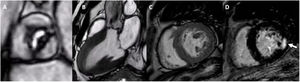 Resonancia magnética cardiovascular de un paciente con estenosis aórtica grave. Las imágenes de cine de la válvula aórtica (A), las proyecciones de 3 cámaras (B) y las proyecciones de eje corto (C) del ventrículo izquierdo muestran la apertura restrictiva de la válvula aórtica y la marcada hipertrofia del ventrículo izquierdo. D: realce tardío de gadolinio en el eje corto del ventrículo izquierdo con fibrosis focal en el segmento posterior (flecha).