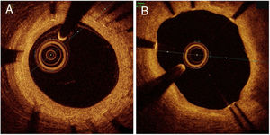 Imágenes de tomografía de coherencia óptica representativas de cicatrización neointimal a los 6 meses de seguimiento. A: neoíntima gruesa por toda la circunferencia. B: neoíntima delgada con struts no recubiertos situados a las cinco en punto.