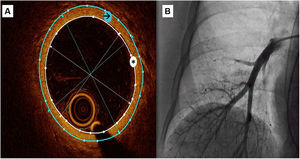 Figura central. Registro de OCT de una arteria pulmonar subsegmentaria. A: se utilizó un método semiautomático para medir el área de la luz (asterisco blanco) y el área de la pared vascular externa (flecha negra), y luego se obtuvieron automáticamente los diámetros medios interno y externo. Se calculó el grosor intimal como (diámetro externo - diámetro interno)/2 y el área del grosor intimal como diferencia entre el área externa y el área interna. B: angiografía pulmonar durante el registro de OCT.