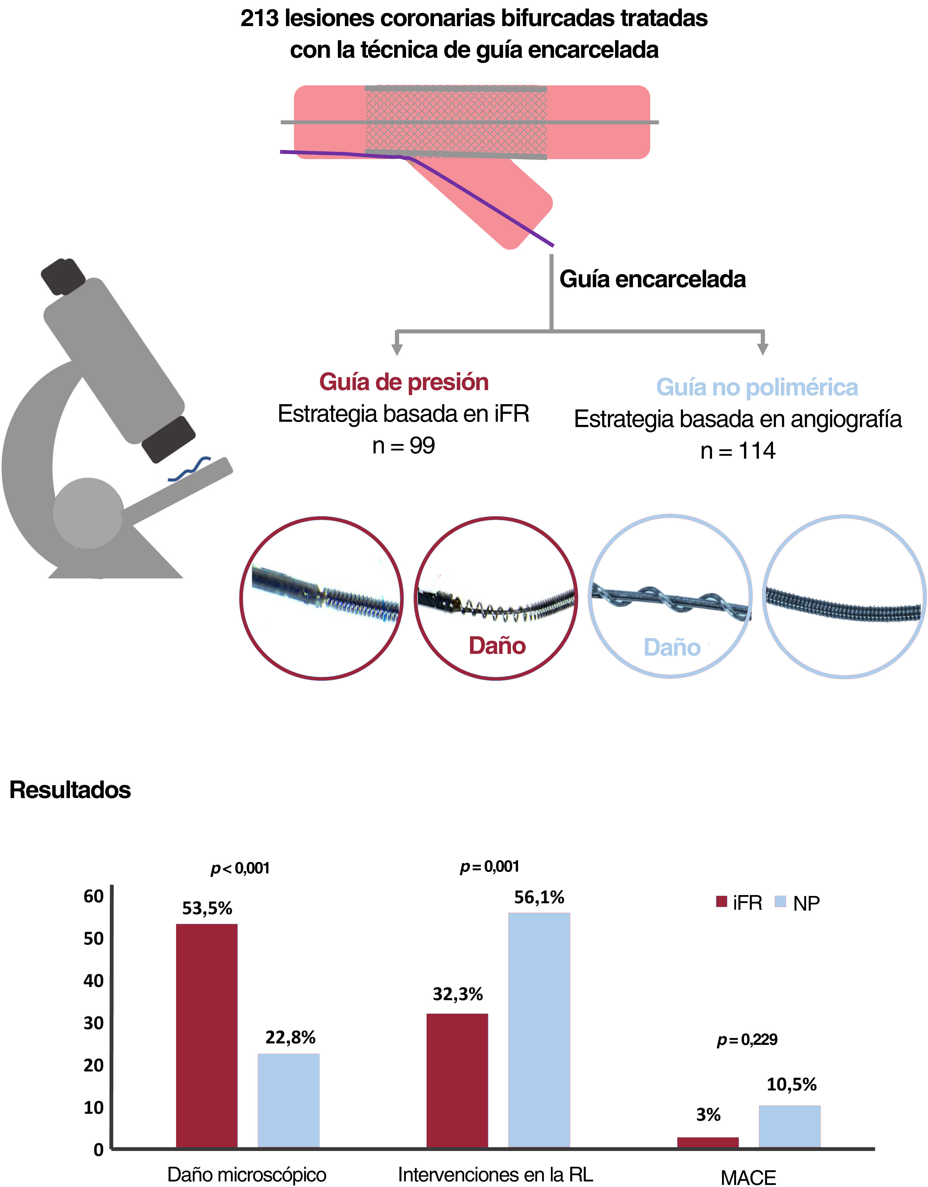 Guía de presión encarcelada en el tratamiento percutáneo de las ...