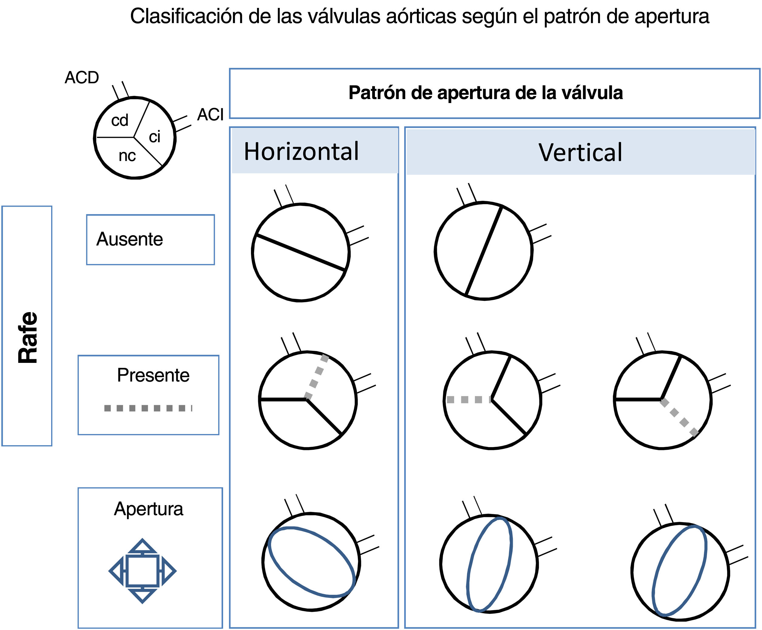 válvula aórtica bicúspide