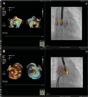 Graphical Abstract Imagen de fusión ecocardiográfica-fluoroscópica...