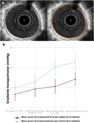 Graphical Abstract Evaluación del remodelado vascular pulmonar adver...