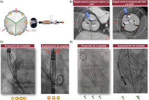 Graphical Abstract Alineación comisural con la bioprótesis aórtica...