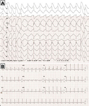 Graphical Abstract Signo del casco prusiano en el electrocardiograma ...