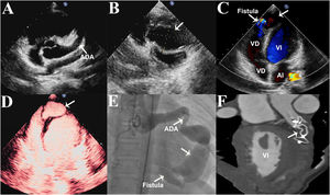 Graphical Abstract Aneurisma septal disecante como complicación de u...