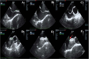 Graphical Abstract Punción transeptal para FOP con cierre de aneuris...