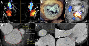 Graphical Abstract Reemplazo percutáneo valvular mitral. El inicio d...